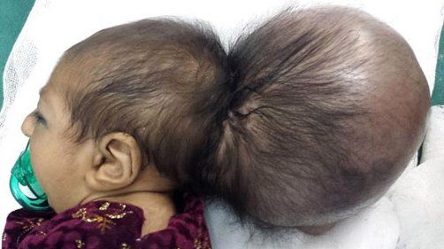 طفلة ولدت برأسين 1 طفلة ولدت برأسين 1