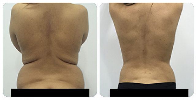 Lipoaspiration Lipoaspiration