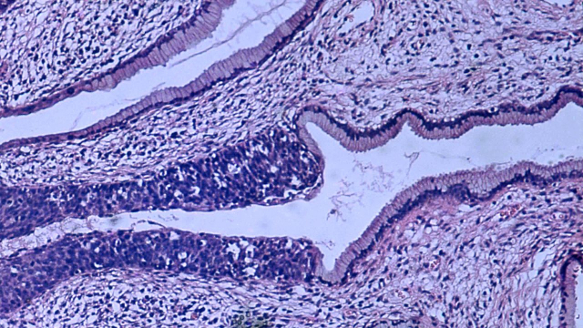 Cancer du col de l utérus - Carcinome - Photographie au microscope - Cancer utérin