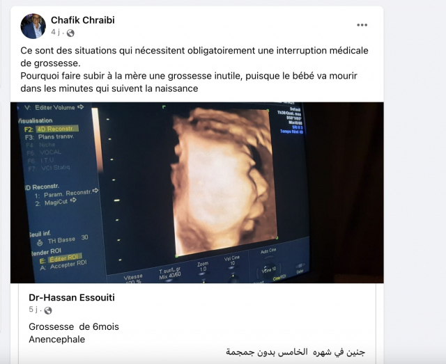 Facebook post of Pr. Chafik Chraïbi - Abortion - Abortion - Anencephalic fetus - Debate on abortion