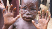 Cameroun: des cas de variole du singe soulèvent un vent de panique dans le pays